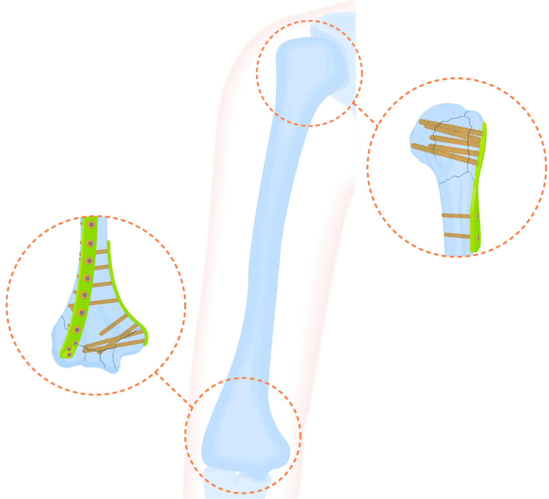 Fracture of the neck of the humerus