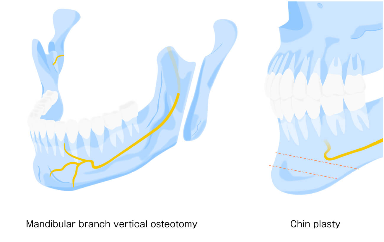 下顎枝垂直骨切術_オトガイ形成術