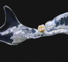 Implantation of artificial tooth root