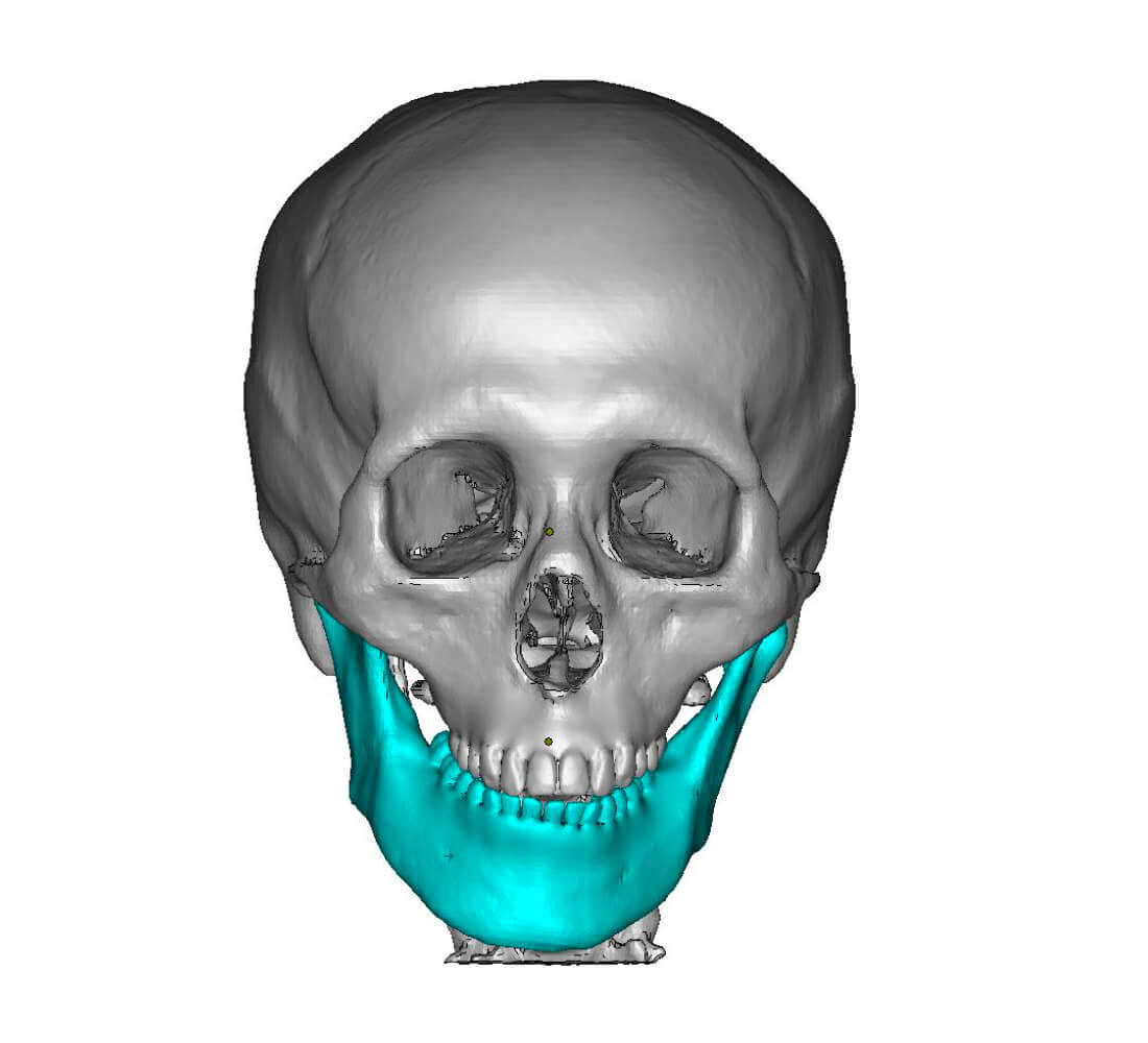 Jaw deformity