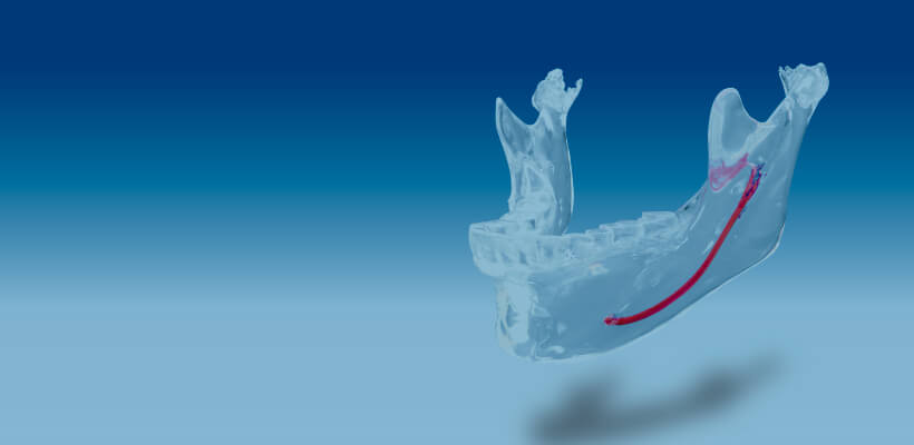 Facial contouring, Inferior alveolar canal