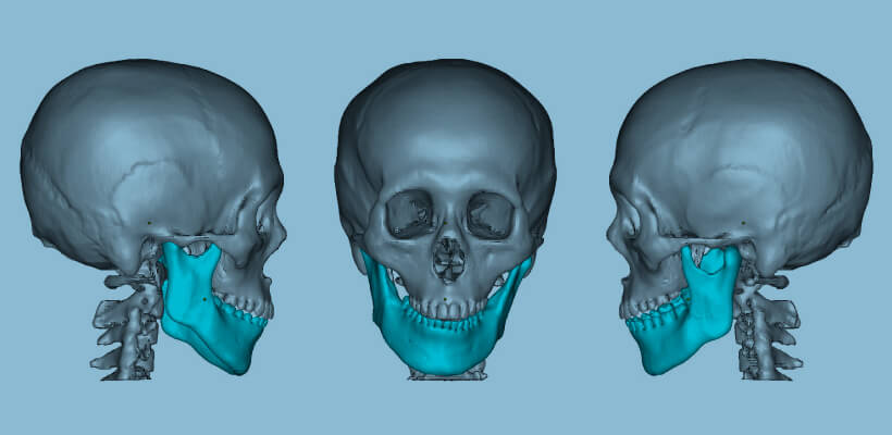 Jaw deformity