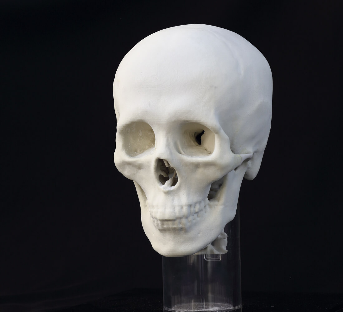 Cranial reconstruction