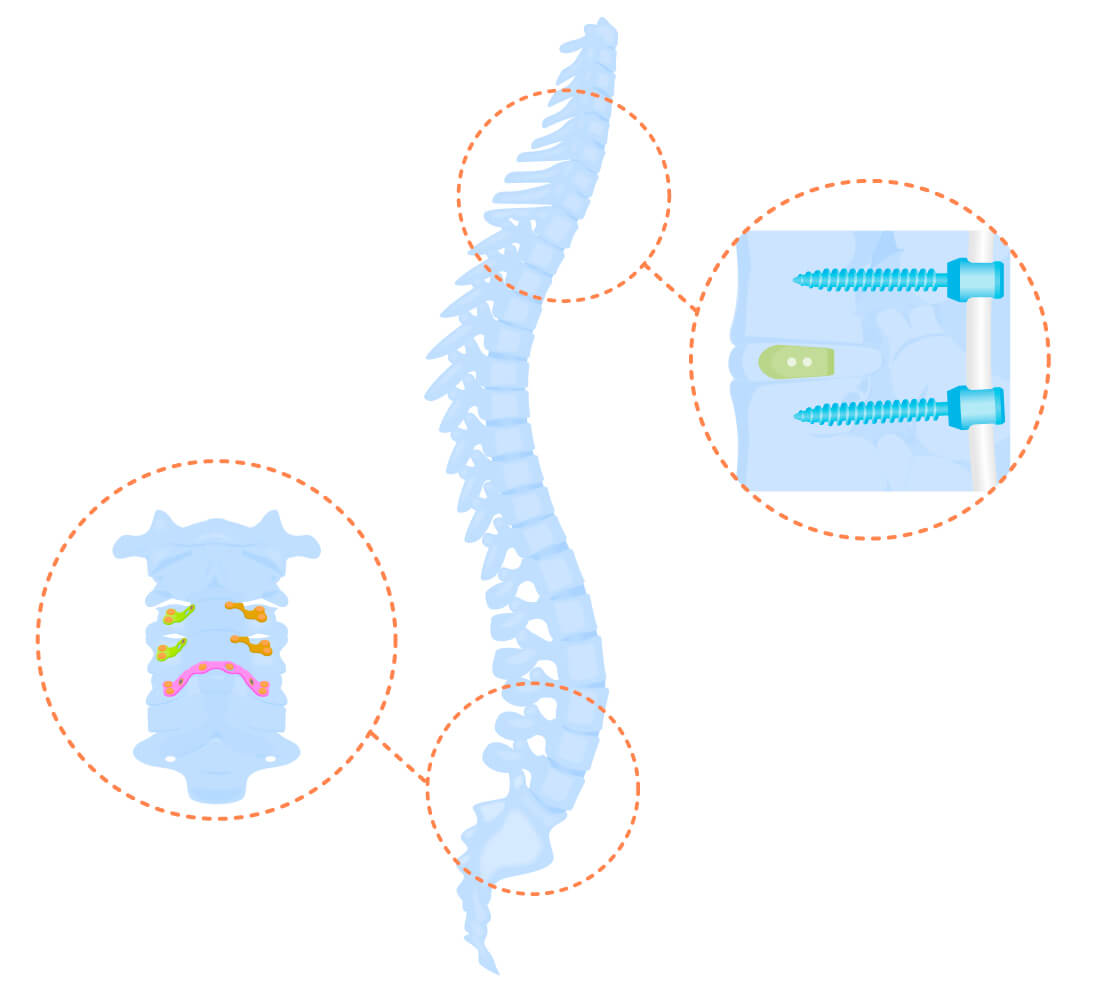 Bone splicing material treatment