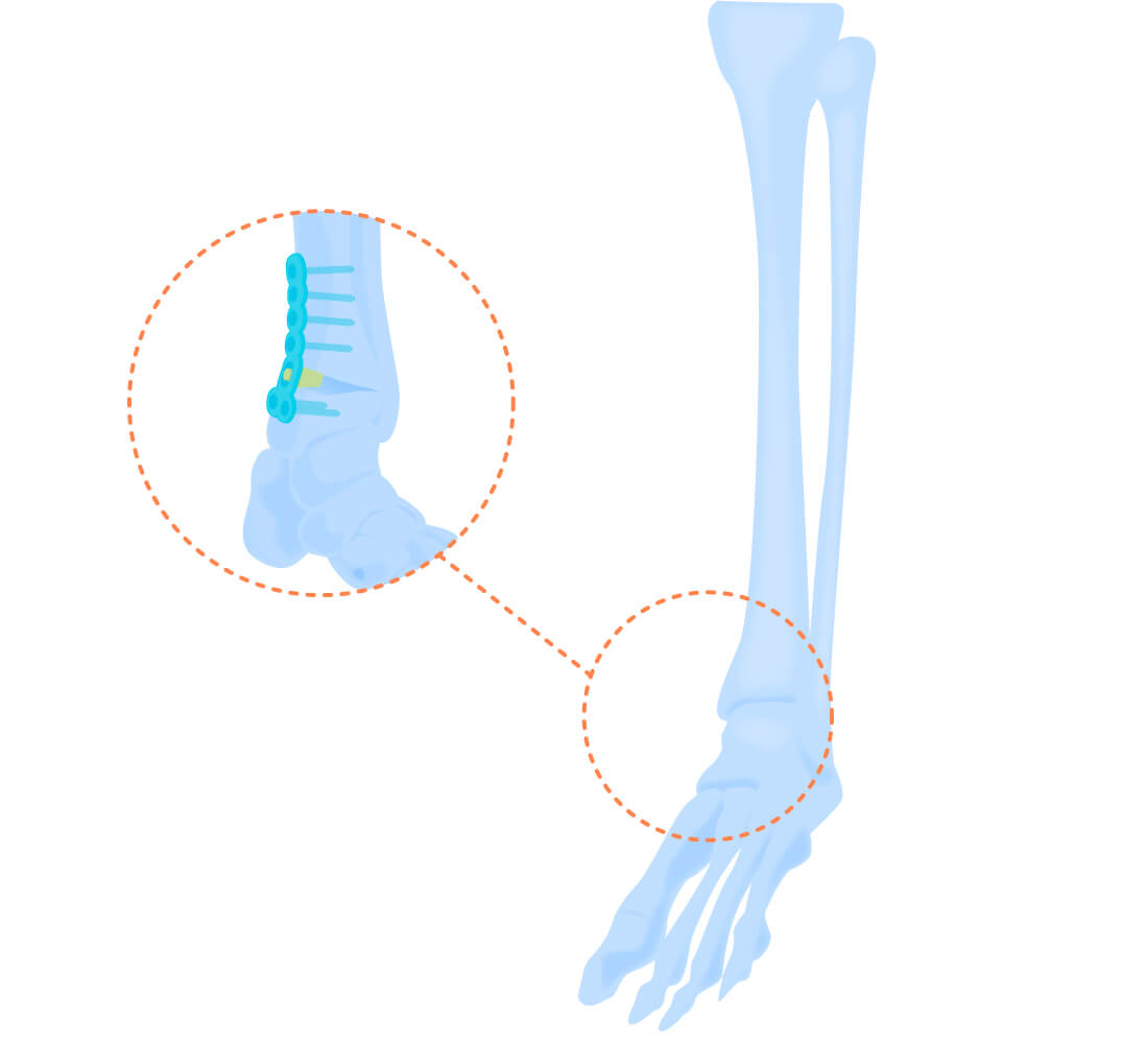 Tibia Fracture Treatment