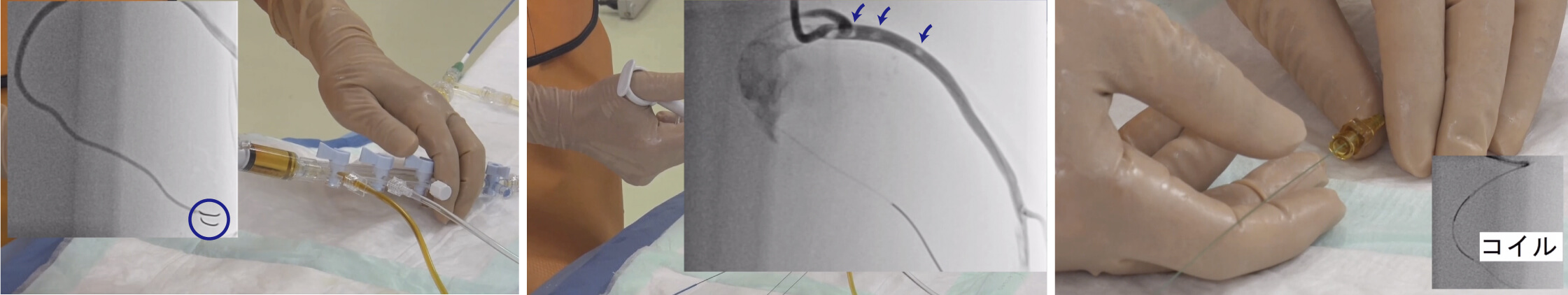 Air embolization_coiling for coronary artery perforation